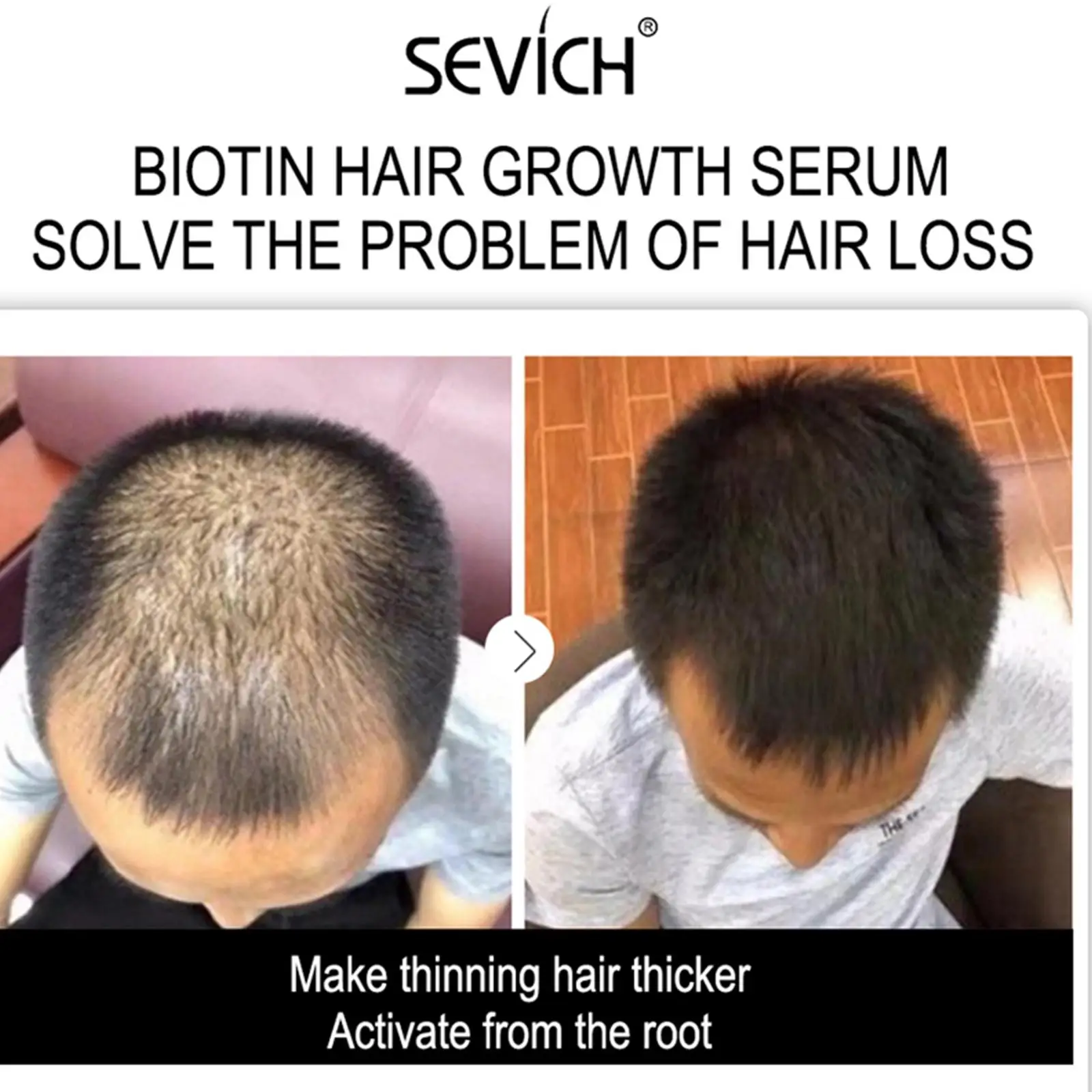 Baldness Embarrassing You. Sevich Scalp Concealer Helps You Take Back Control