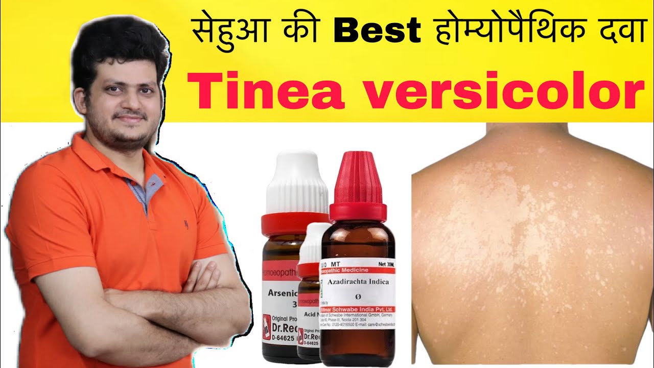 How to Get Rid of Tinea Versicolor Rash For Good: 3 Effective Treatments You Must Try