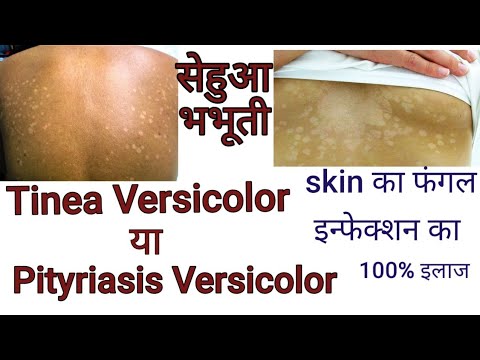 How to Get Rid of Tinea Versicolor Rash For Good: 3 Effective Treatments You Must Try