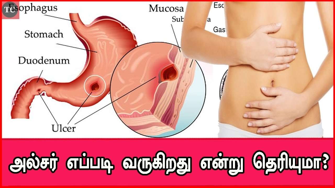 How to Cure Gastritis Fast in 9 Easy Steps