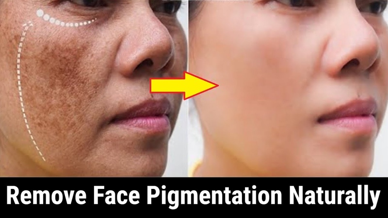 How to Remove Dark Spots from Your Face Naturally: Discover 10 Effective Dermisa Skin Fade Creams